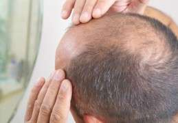 Acquire Permanent Solution to Hair Loss