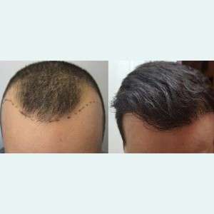Hair Loss Treatment in Delhi