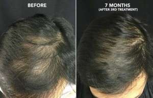 Hair Treatment in Delhi