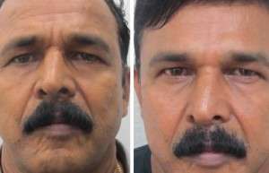 Non-Invasive & Liquid Face Lift in Delhi
