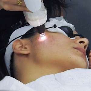 Q-switch Laser Treatment in Delhi